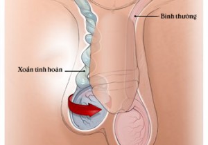 Trường Hợp Xoắn Tinh Hoàn Hiếm Gặp