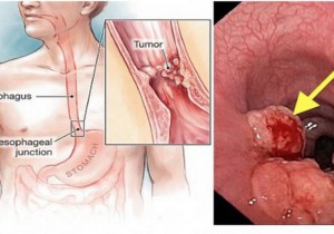 CHỦ ĐỀ SỨC KHỎE SỐ 33: TẦM SOÁT UNG THƯ THỰC QUẢN