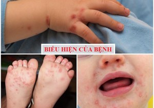 CHỦ ĐỀ SỨC KHỎE SỐ 37: PHÒNG BỆNH TAY - CHÂN - MIỆNG Ở TRẺ NHỎ