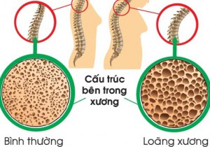 CHỦ ĐỀ SỨC KHỎE SỐ 42: NHỮNG ĐIỀU BẠN CẦN BIẾT VỀ LOÃNG XƯƠNG