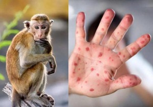 HƯỚNG DẪN CHẨN ĐOÁN, ĐIỀU TRỊ VÀ PHÒNG BỆNH ĐẬU MÙA KHỈ Ở NGƯỜI