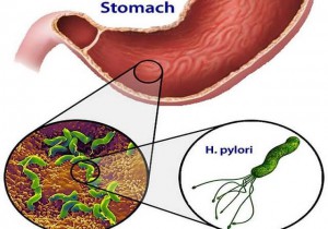 VI KHUẨN HP (Helicobacter pylori) LÀ GÌ – CHÚNG TA CẦN LÀM GÌ KHI NHIỄM VI KHUẨN HP