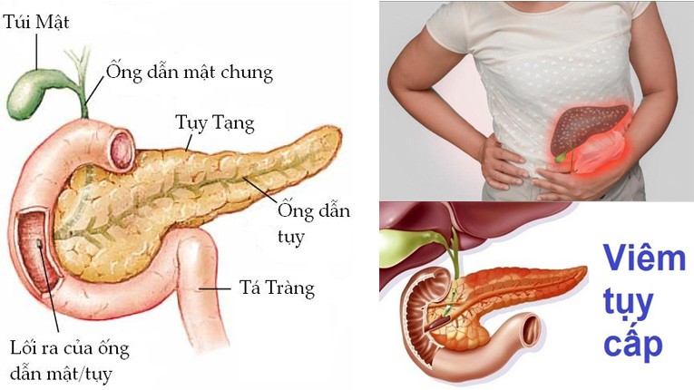 VIÊM TỤY CẤP