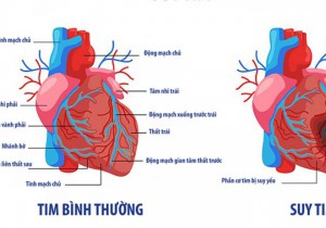 NHỮNG ĐIỀU CẦN BIẾT VỀ SUY TIM