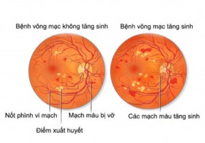 BỆNH VÕNG MẠC ĐÁI THÁO ĐƯỜNG