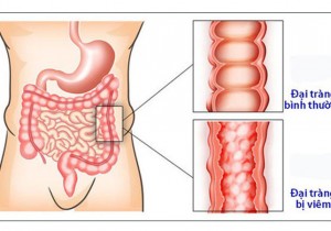 NHỮNG ĐIỀU CẦN BIẾT VỀ VIÊM ĐẠI TRÀNG