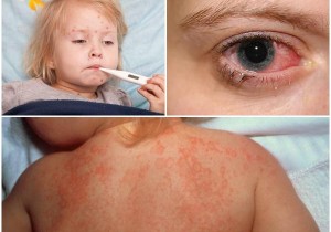 CHĂM SÓC TRẺ NHIỄM SIÊU VI