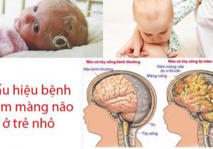 BỆNH VIÊM MÀNG NÃO Ở TRẺ EM