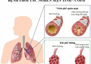 Tư vấn sức khỏe: Bệnh phổi tắc nghẽn mãn tính