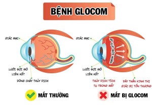 Tư vấn sức khỏe: Sự nguy hiểm của bệnh lý Glocom