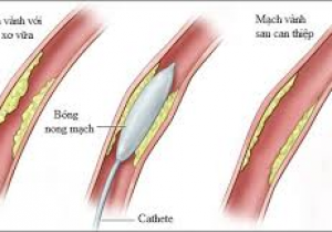 Thông báo về việc mời chào giá các mặt hàng VTYT dùng trong DSA