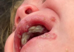 BỆNH HERPES MÔI Ở TRẺ EM