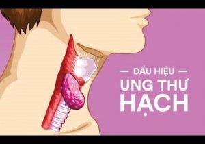 NHỮNG ĐIỀU CẦN BIẾT VỀ UNG THƯ HẠCH