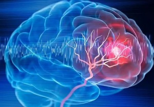 Sa sút trí tuệ mạch máu