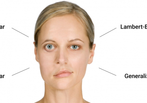 Chẩn đoán và điều trị Bệnh lý Nhược cơ