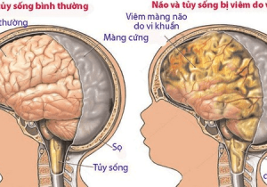 Những điều cần biết về Bệnh lý Viêm màng não mủ