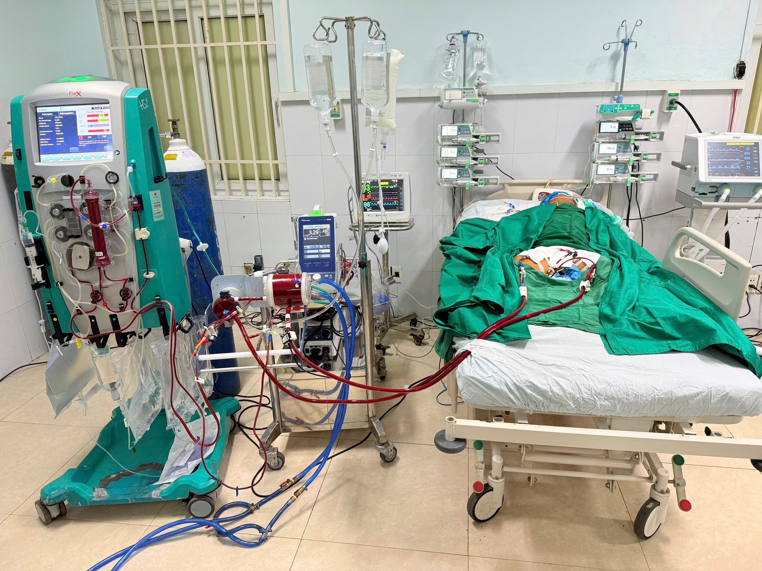 ỨNG DỤNG KỸ THUẬT TIM PHỔI NHÂN TẠO VA-ECMO TRONG ĐIỀU TRỊ VIÊM CƠ TIM CẤP BIẾN CHỨNG SỐC TIM NẶNG: BÁO CÁO CA LÂM SÀNG ĐẦU TIÊN TẠI BVĐK KHU VỰC MIỀN NÚI PHÍA BẮC QUẢNG NAM
